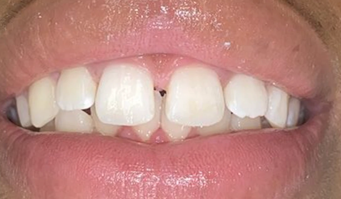 Chipped Tooth Repair — after